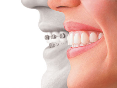 GoodSmiles Dental Care | Viora V30, Invisalign reg  and Botox reg 