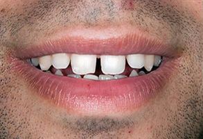 GoodSmiles Dental Care | Root Canals, Dentures and Invisalign reg 